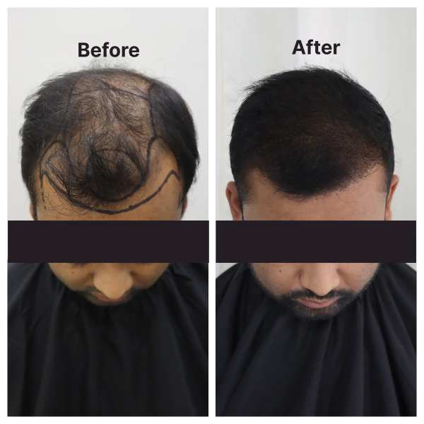 Hair Transplant result KOQ10
